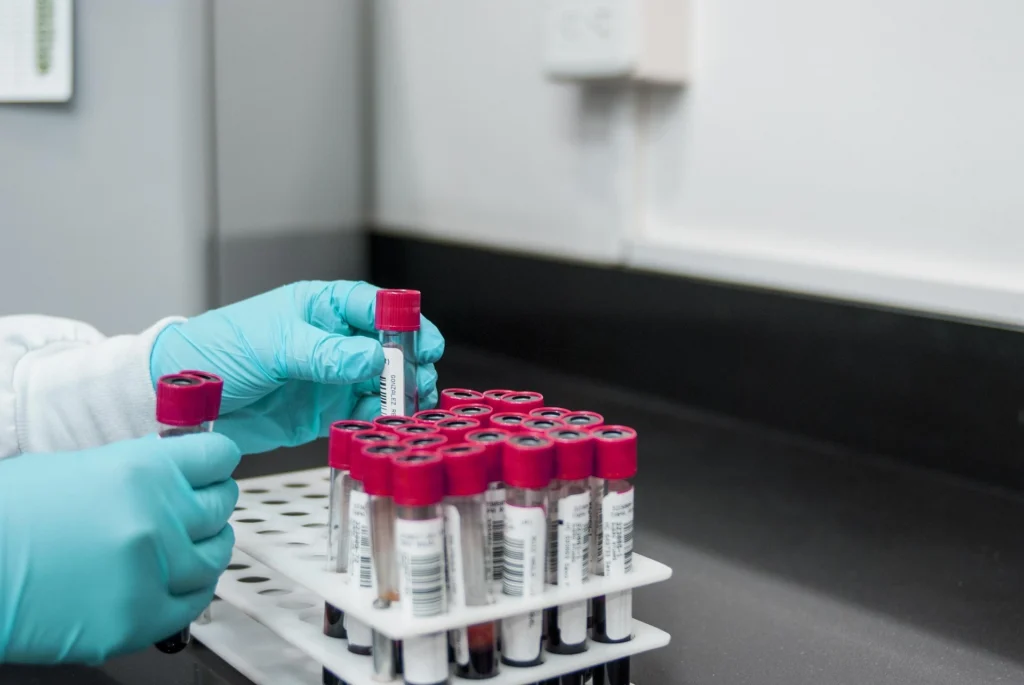 krvne-pretrage-stitnjaca-hashimoto Medicinski laboratorij s epruvetama za krvne pretrage i testiranje funkcije štitnjače